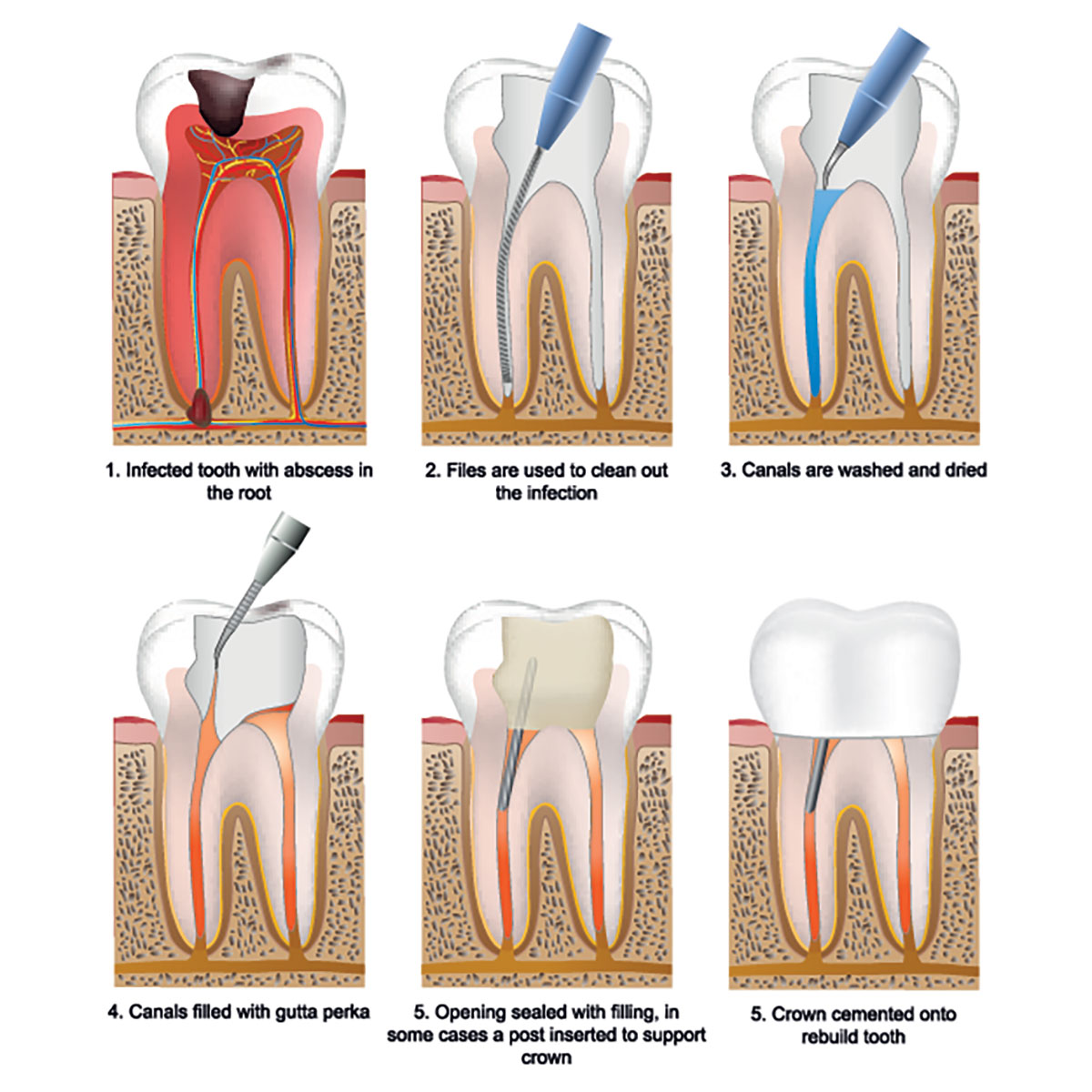 Root Canal Treatment Dentist Parkside